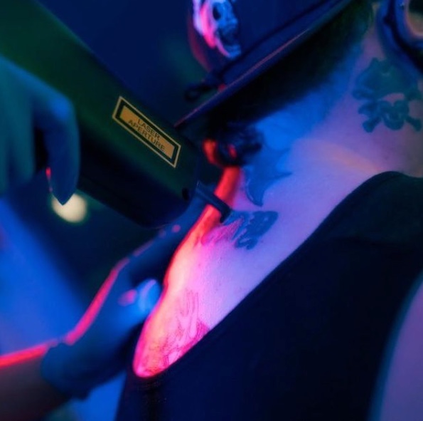 salvation-laser-tattoo-removal-4