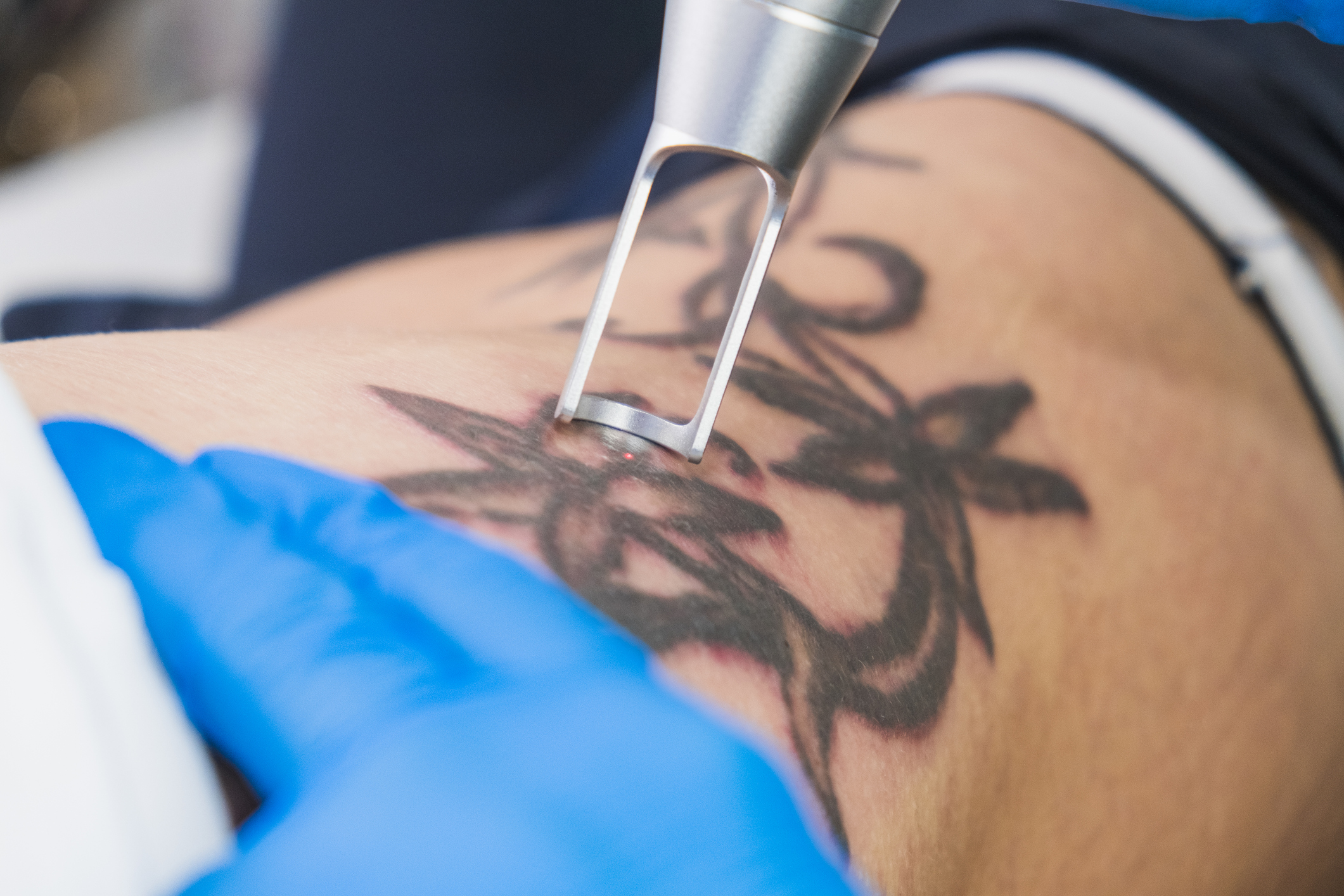 Laser tattoo removal